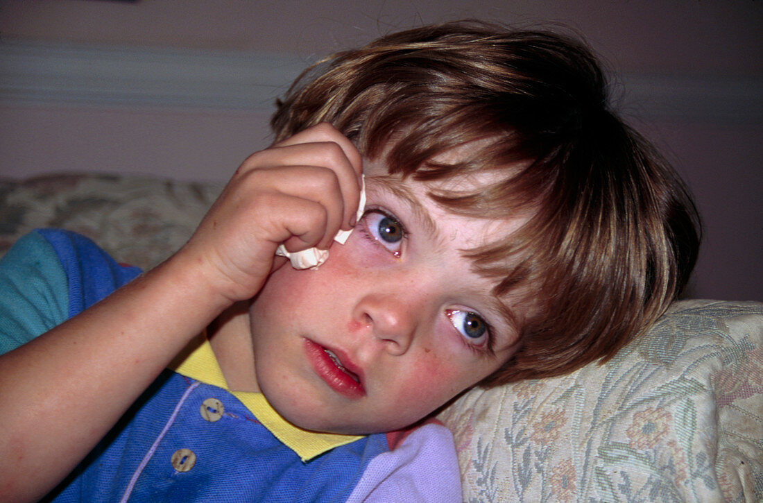 Young boy swabs eye reddened due to conjunctivitis