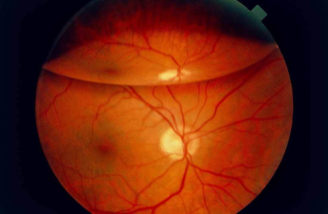 Ophthalmoscopy of detached retina in patient's eye