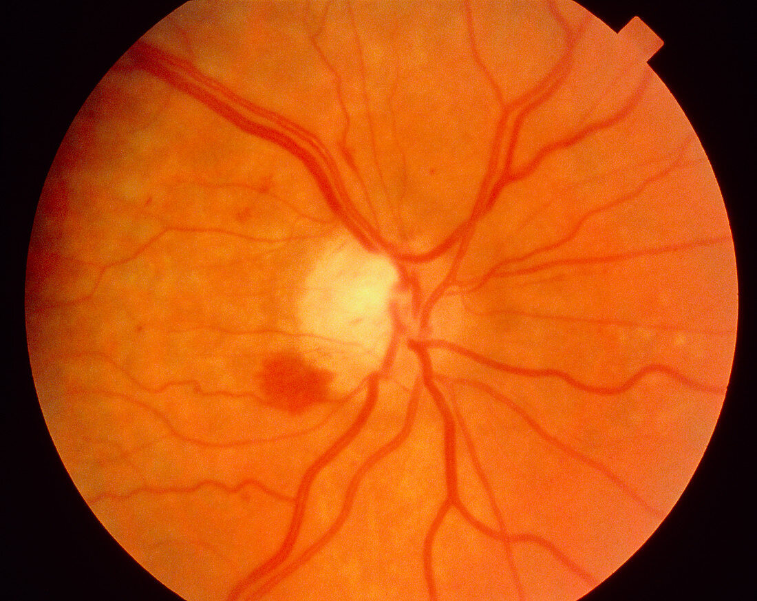 Ophthalmoscopy: haematoma in glaucoma patient eye