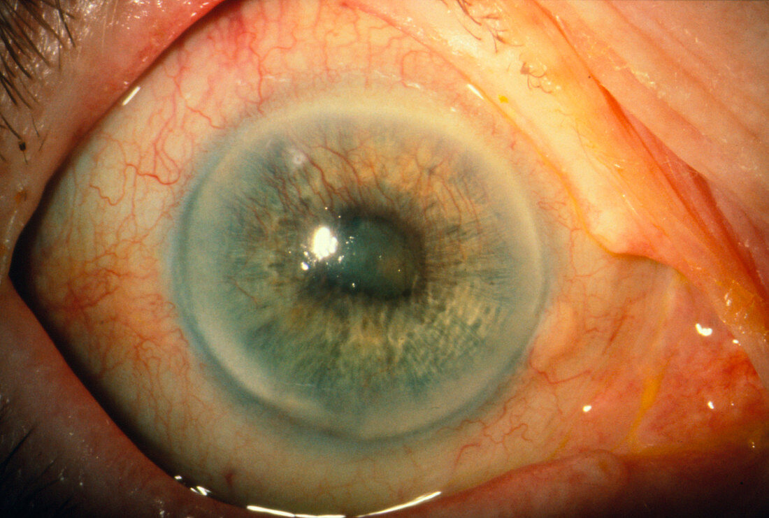 Occluded pupil of patient with rubeosis iridis