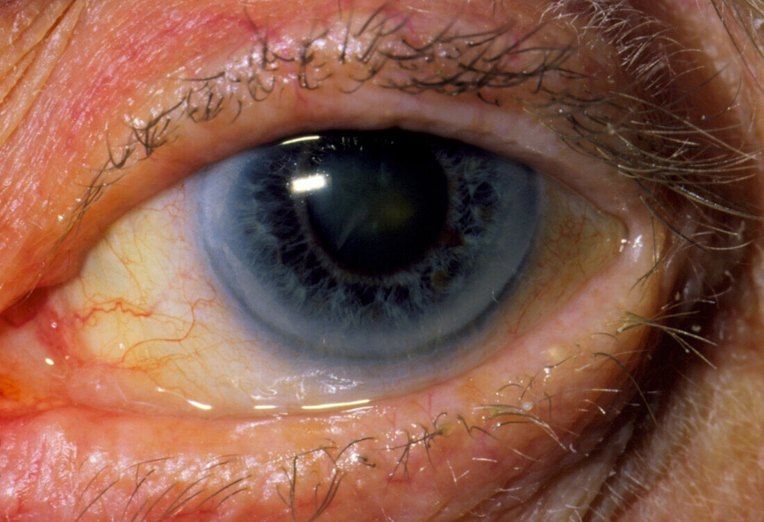 Close-up of patient's eye with mild cataract