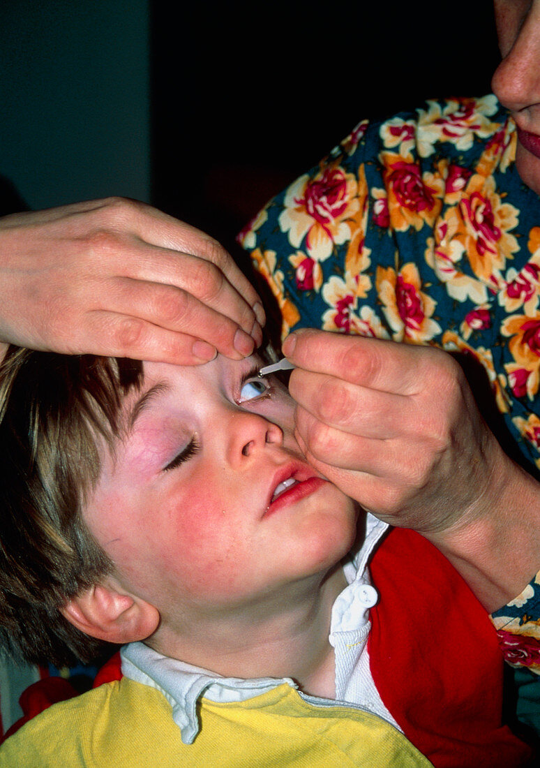 Conjunctivitis: applying eye-drops to child's eye