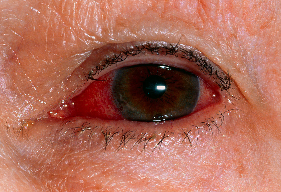 Close-up of eye with viral conjunctivitis