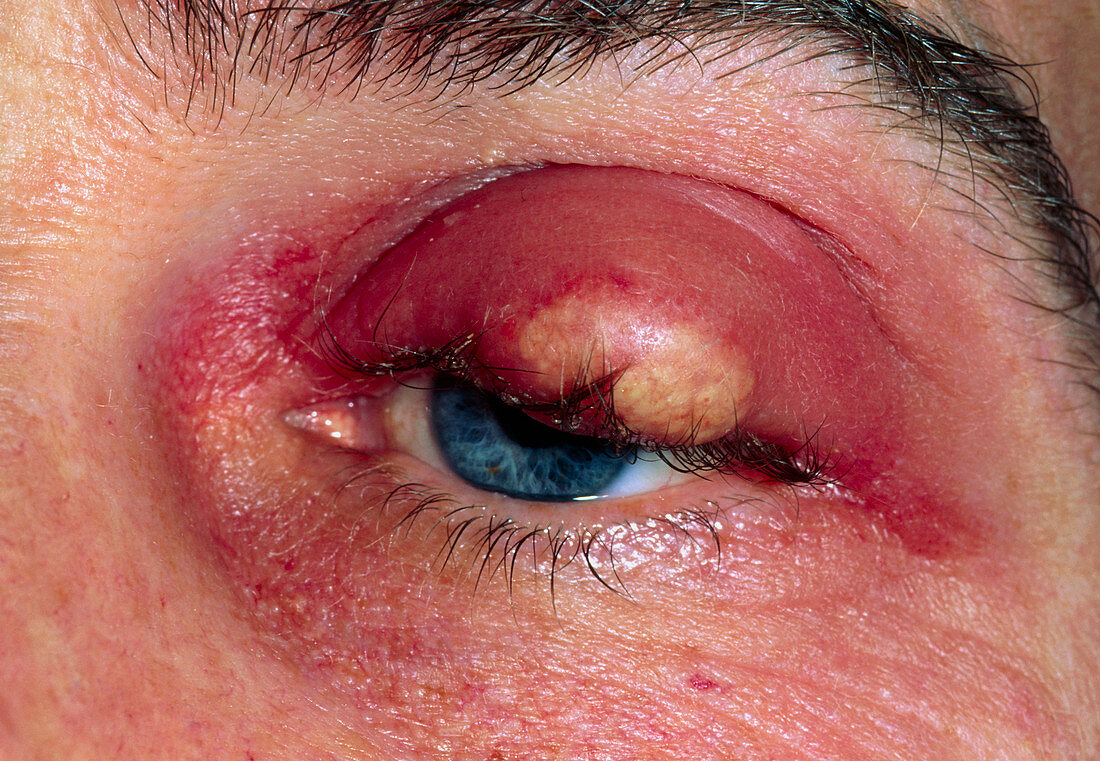 Close up of eye with a meibomian abscess