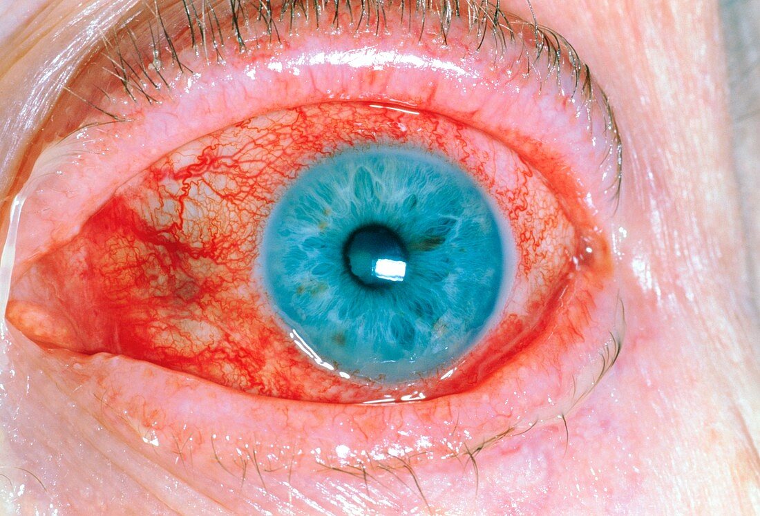 Close up of uveitis in eye of a 77 year old woman