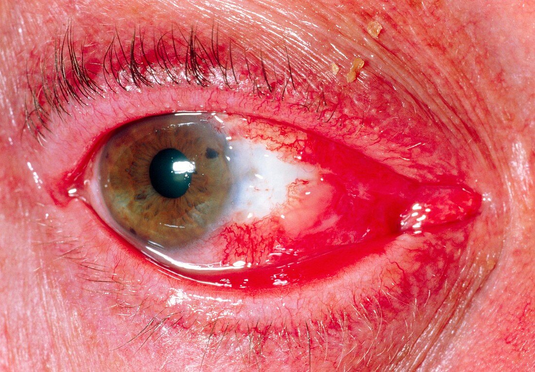 View of an eye after surgery to remove pterygium