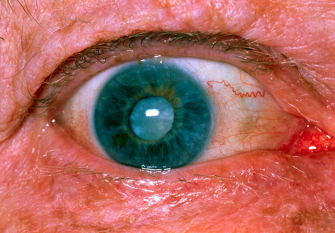 Elderly woman's eye showing cataract