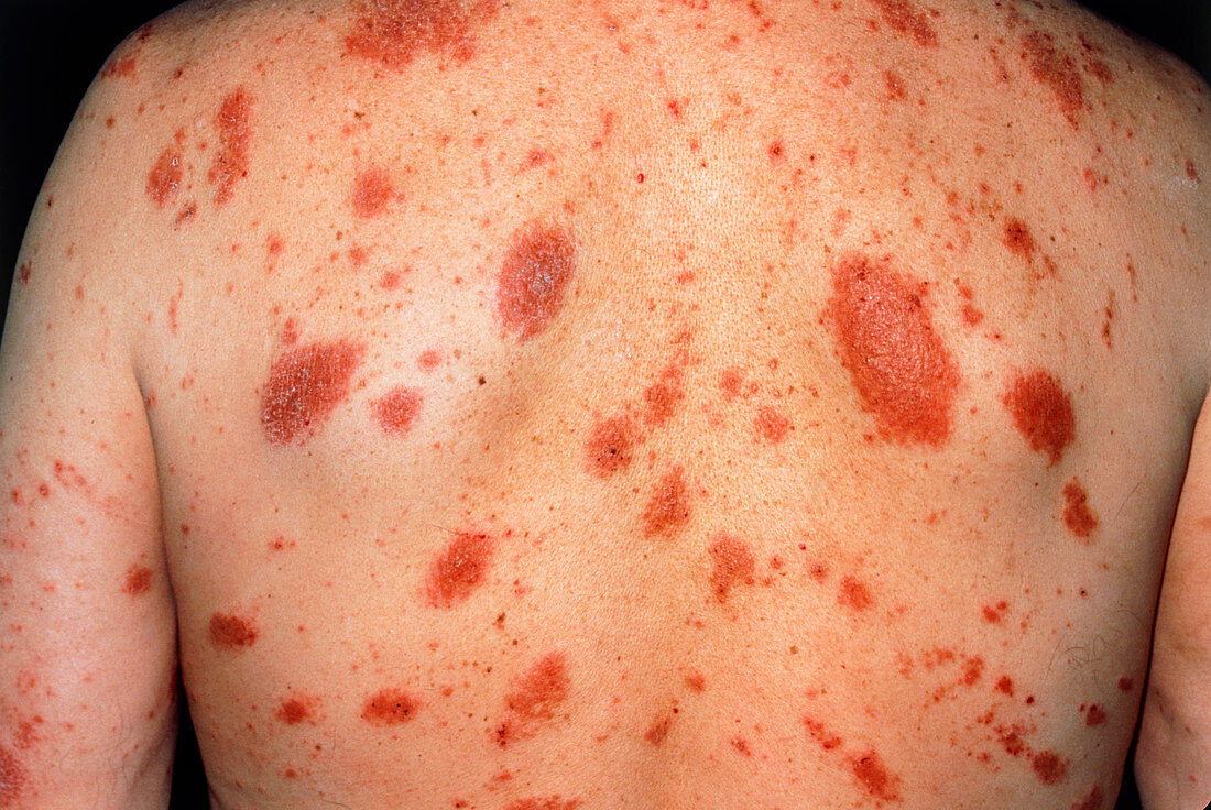 Acute eczema seen on the trunk of 61 year-old man