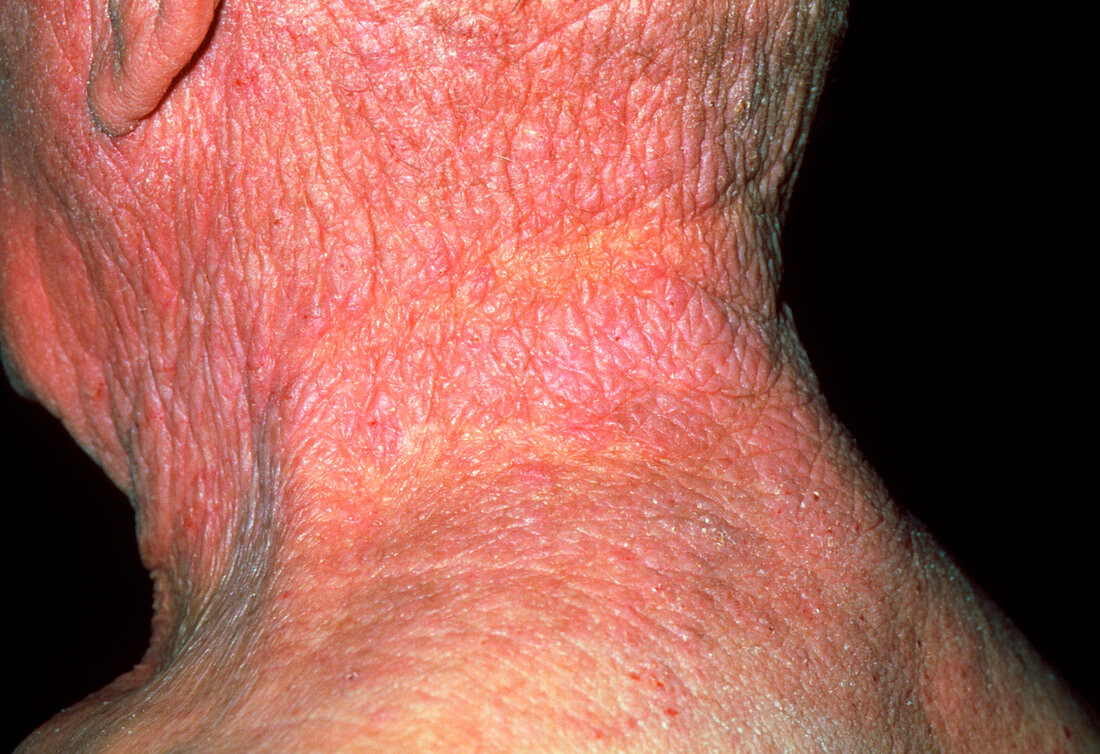 Lichenification caused by eczema on a man's neck