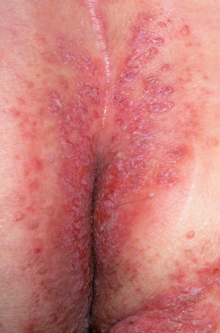 Seborrheic eczema