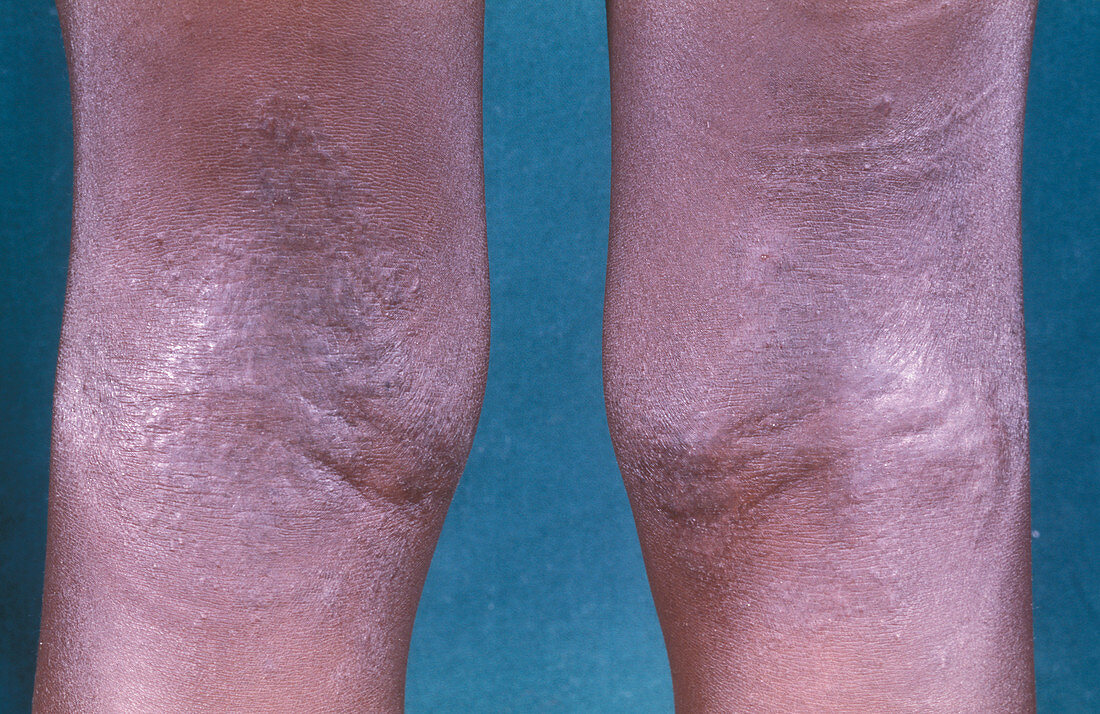 Eczema skin disorder