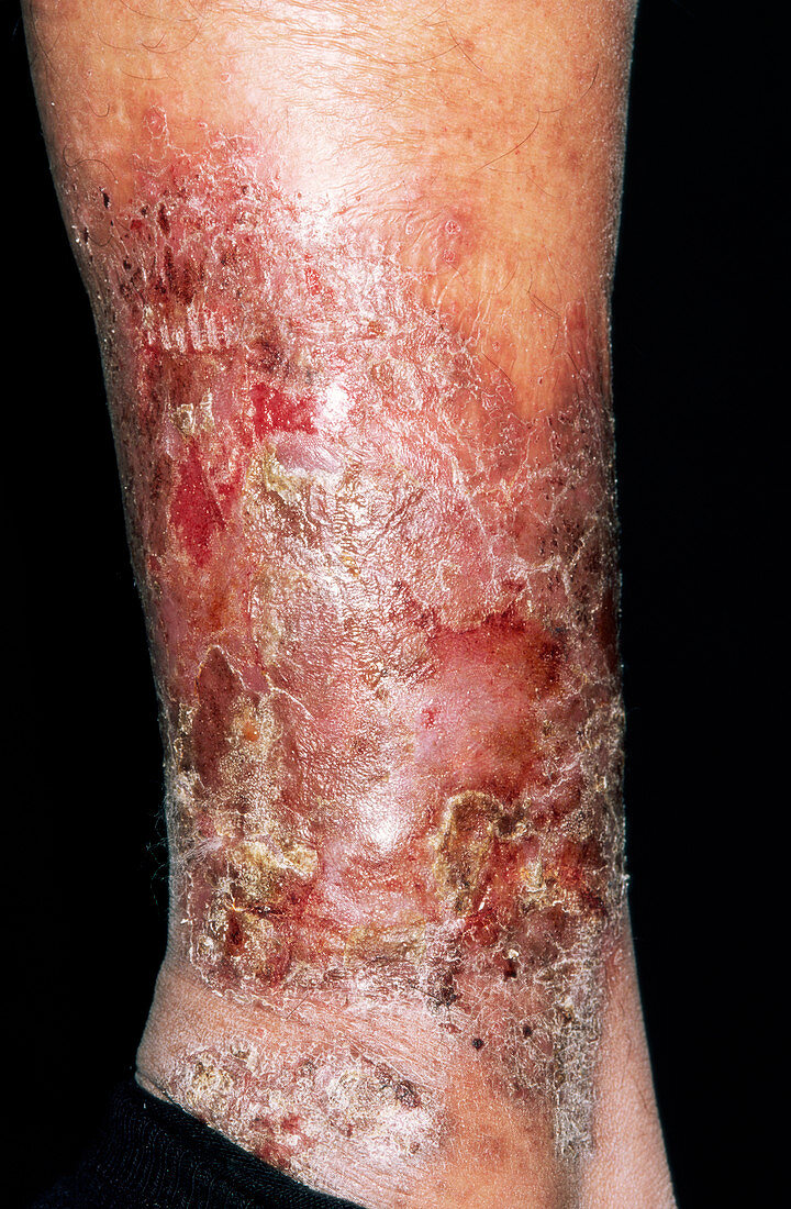 Infected varicose eczema