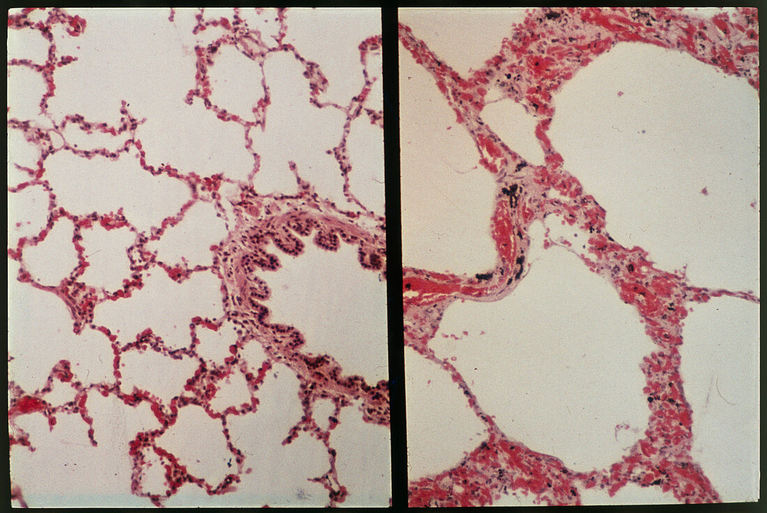 Emphysema in a lung,light micrograph