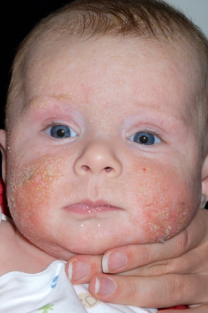 Infected eczema on a baby's face