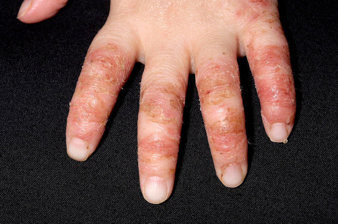 Infected eczema