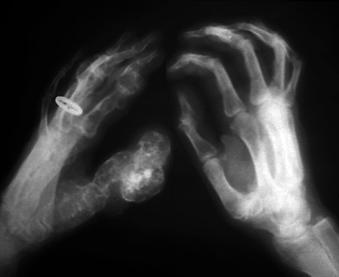 Benign bone tumours,X-ray