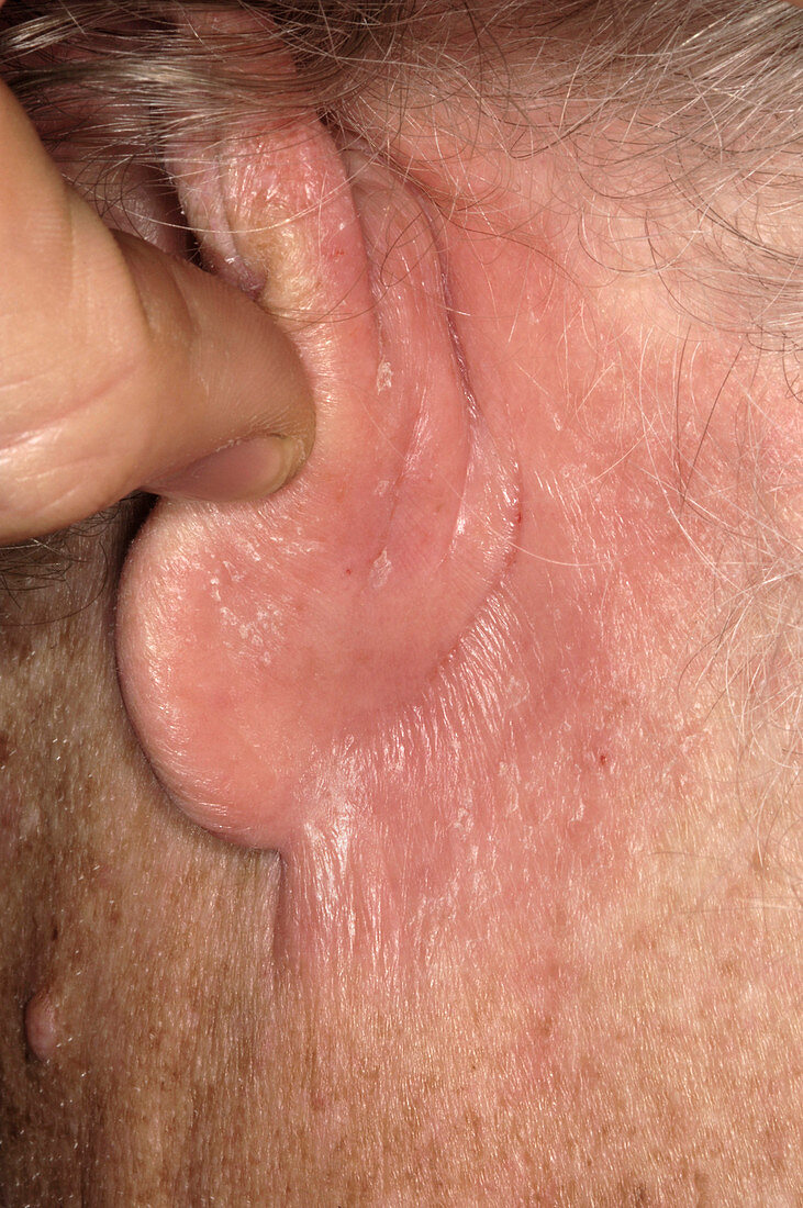 Eczema behind the ear