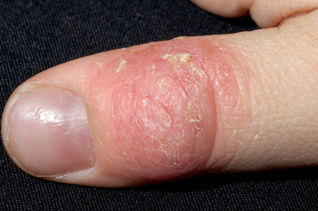 Eczema affecting the thumb
