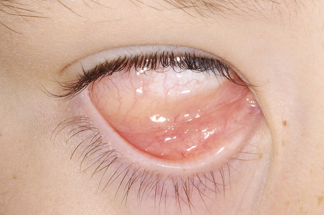 Allergic conjunctivitis and oedema