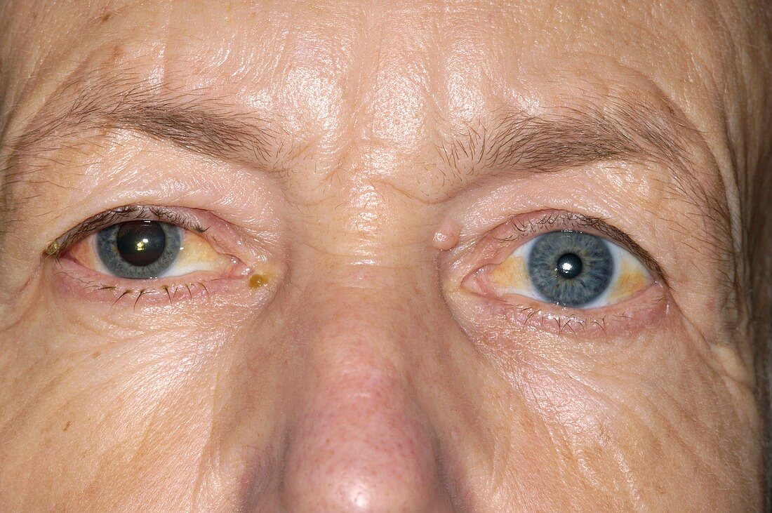 Dilated pupil following retina surgery