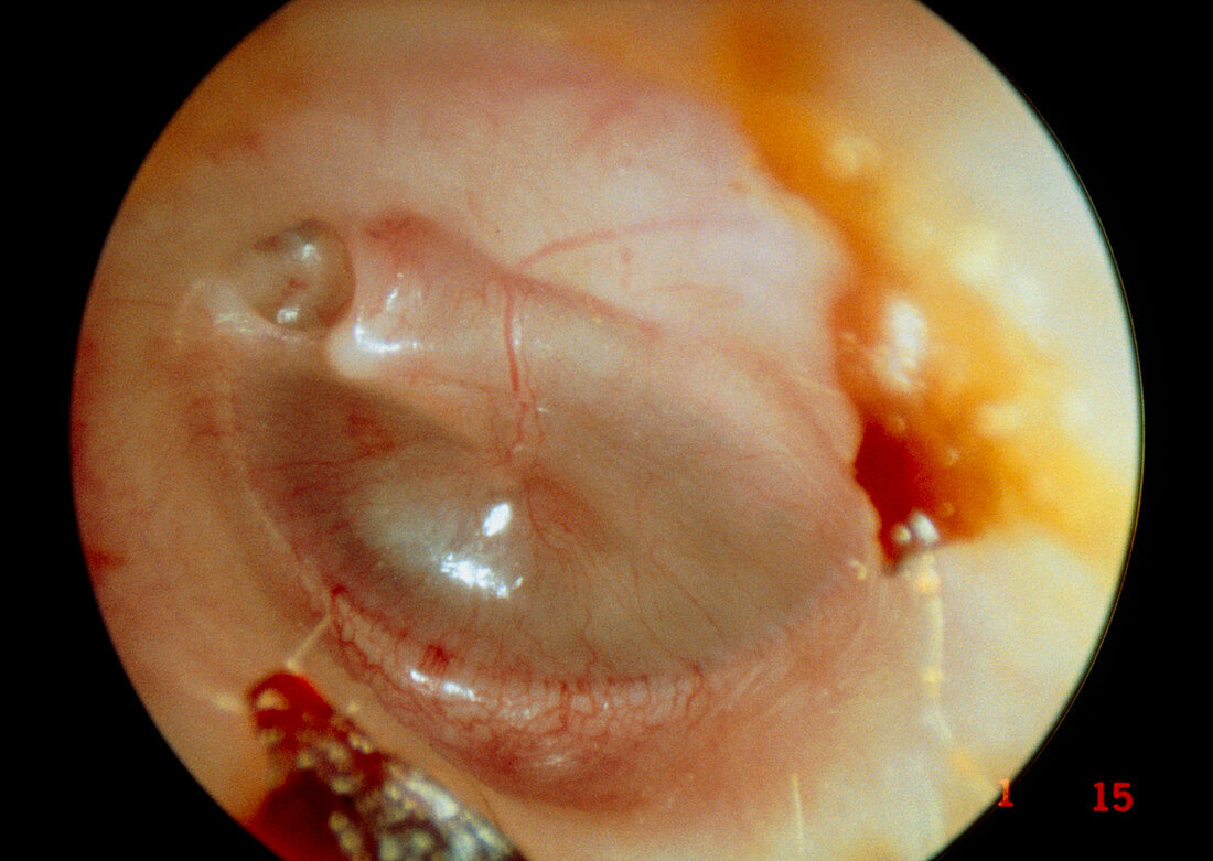 Middle ear in chronic otitis media