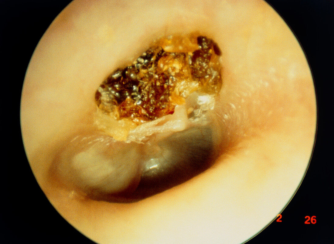 Large cholesteatoma in middle ear