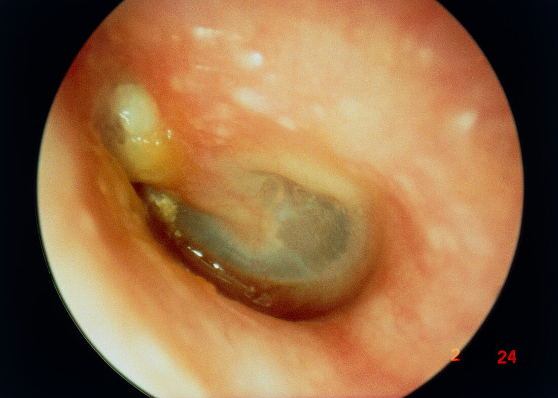Cholesteatoma in middle ear