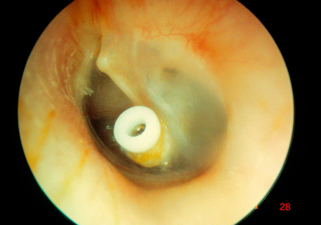 Otitis media of the ear