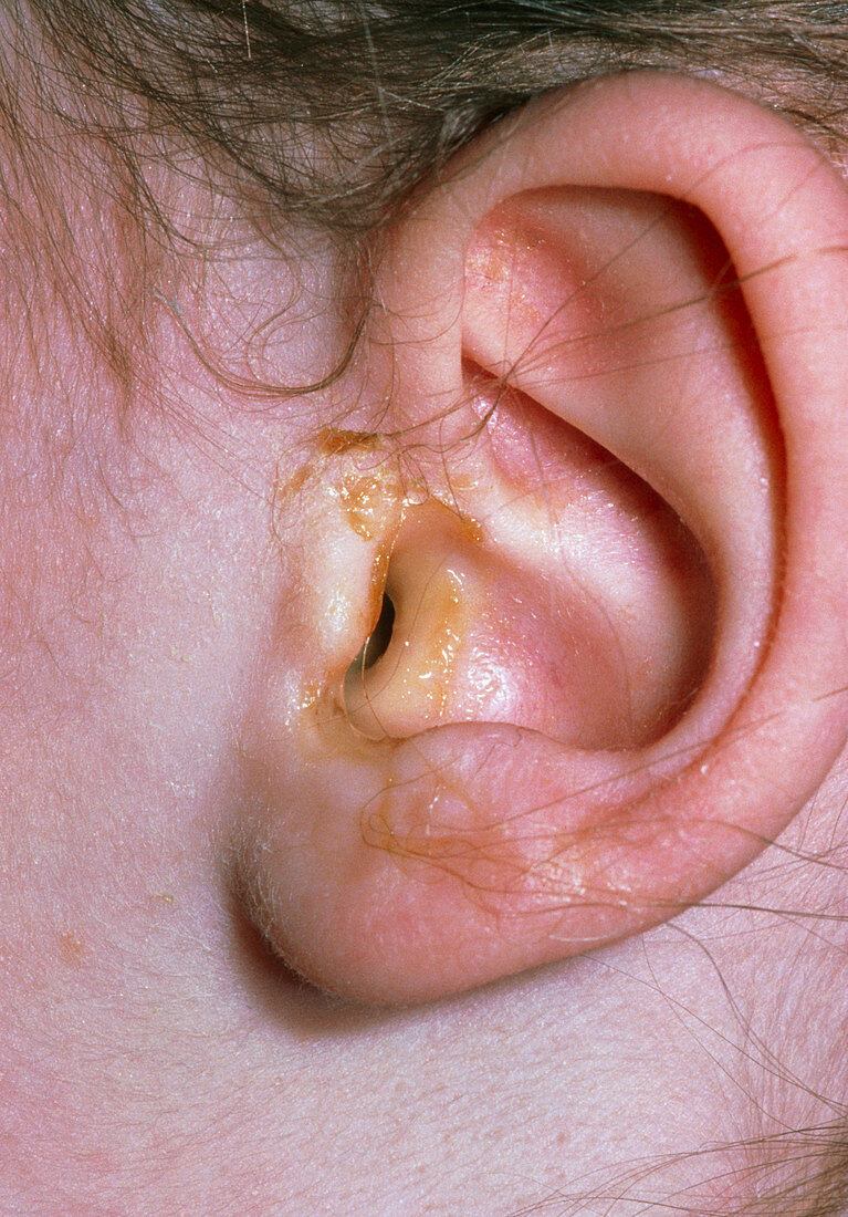 Otitis media of ear