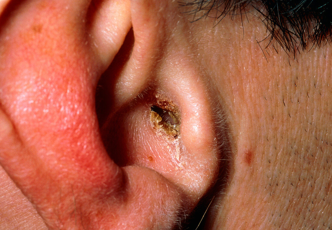 Otitis externa,infected outer ear of male patient