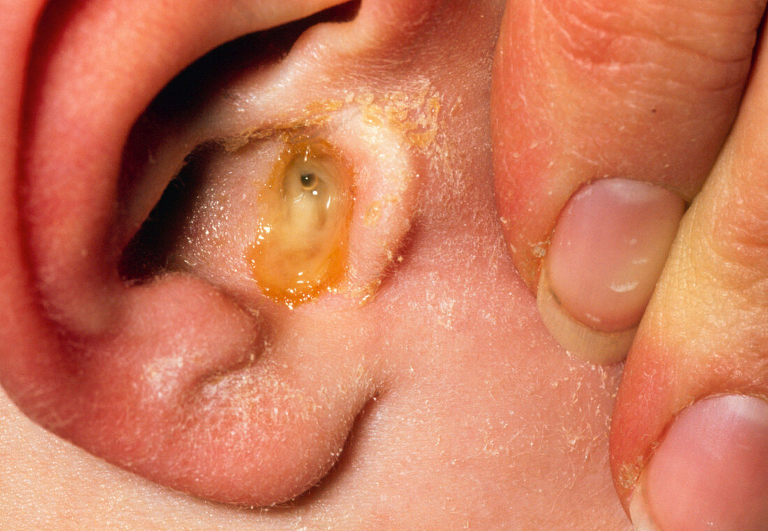 Acute otitis media with perforated eardrum