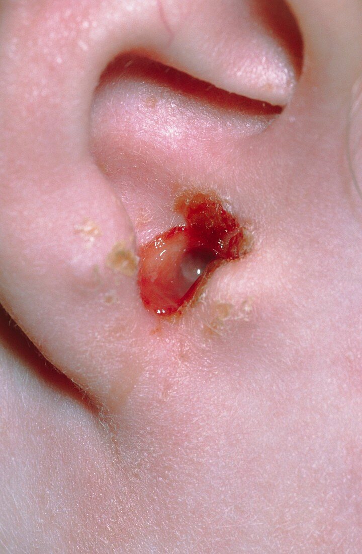 Blood and pus in child's ear due to otitis media