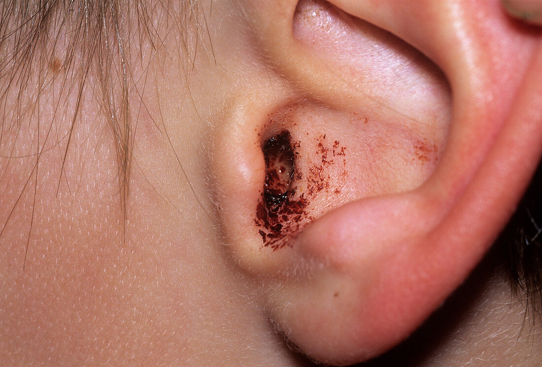 Perforated eardrum