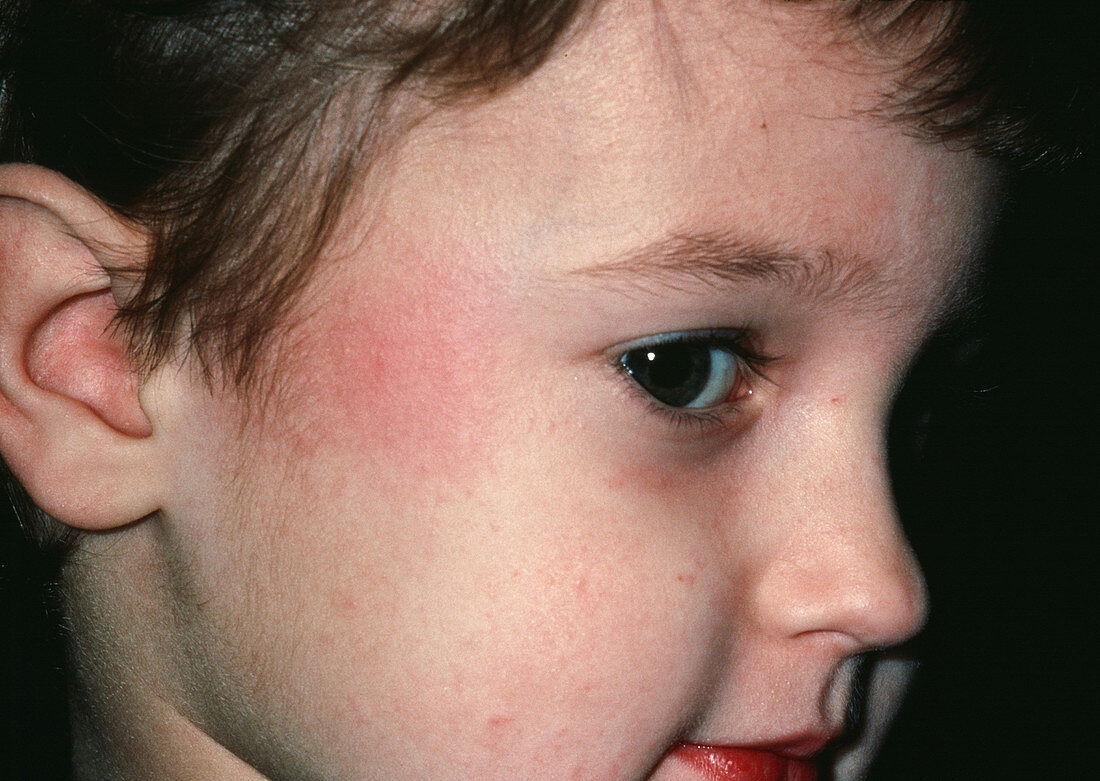 Fifth Disease: slapped cheek mark on boy
