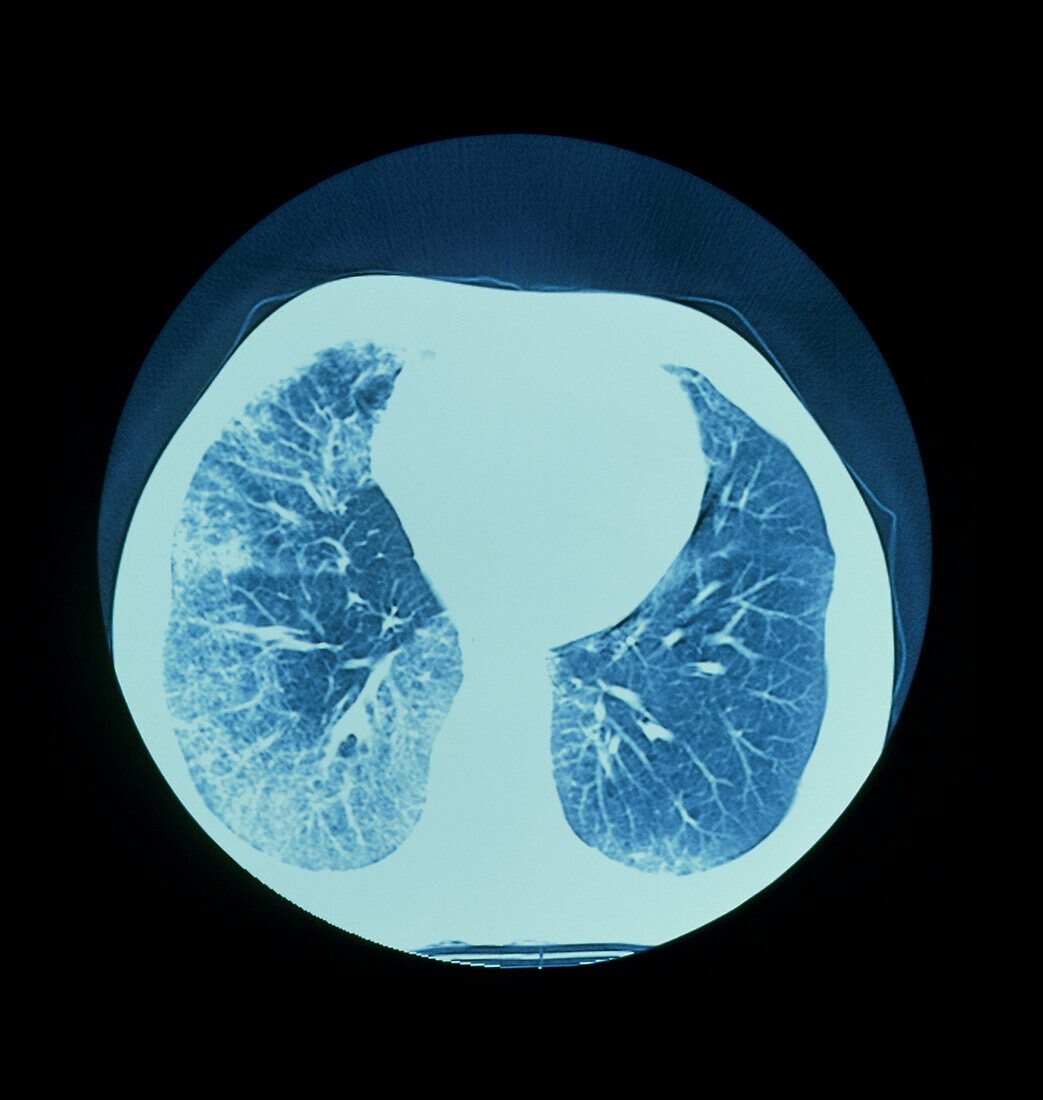 CT scan of lungs showing interstitial fibrosis
