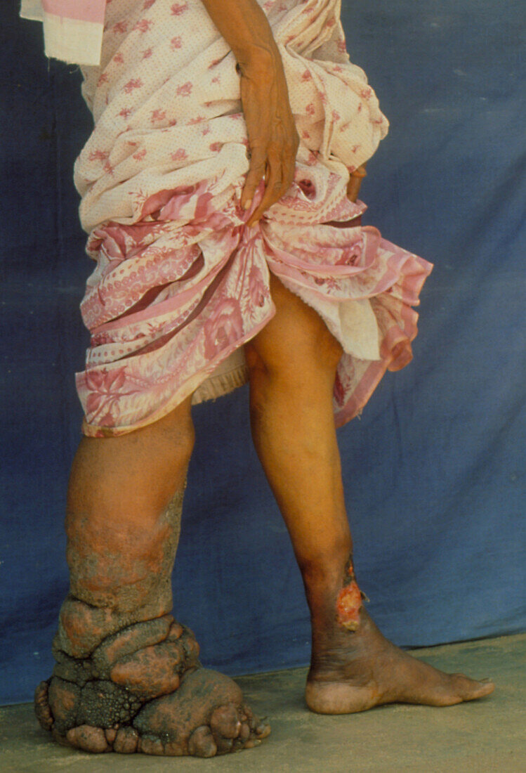 Legs of woman with filariasis,elephantiasis