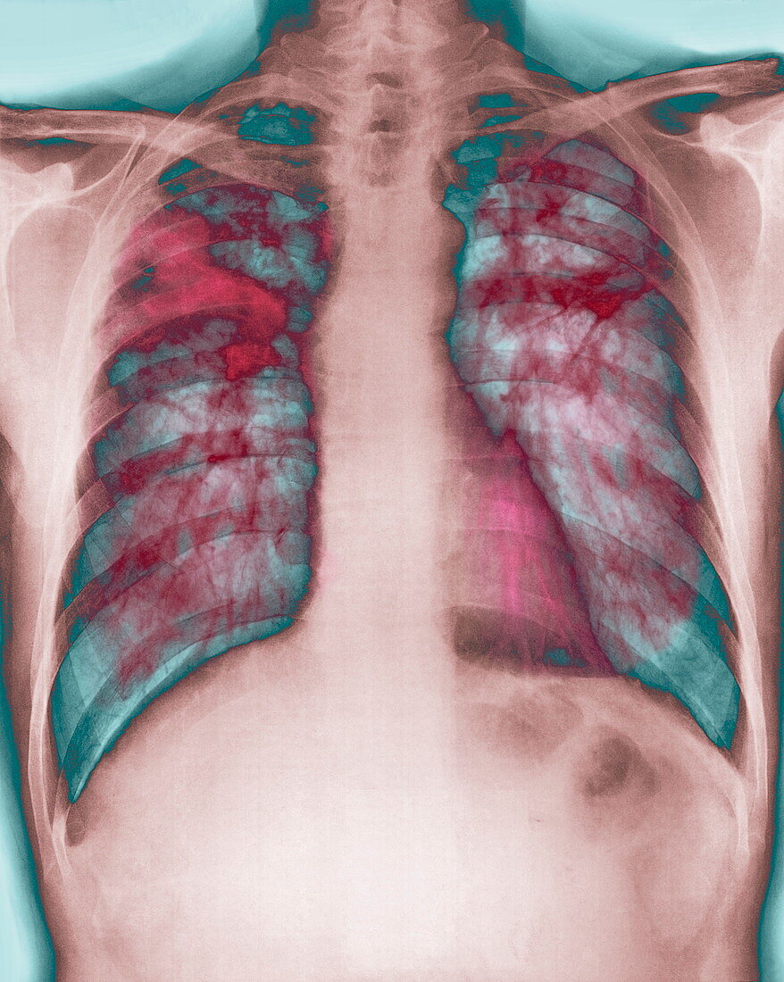 Fibrosis of the lung,X-ray