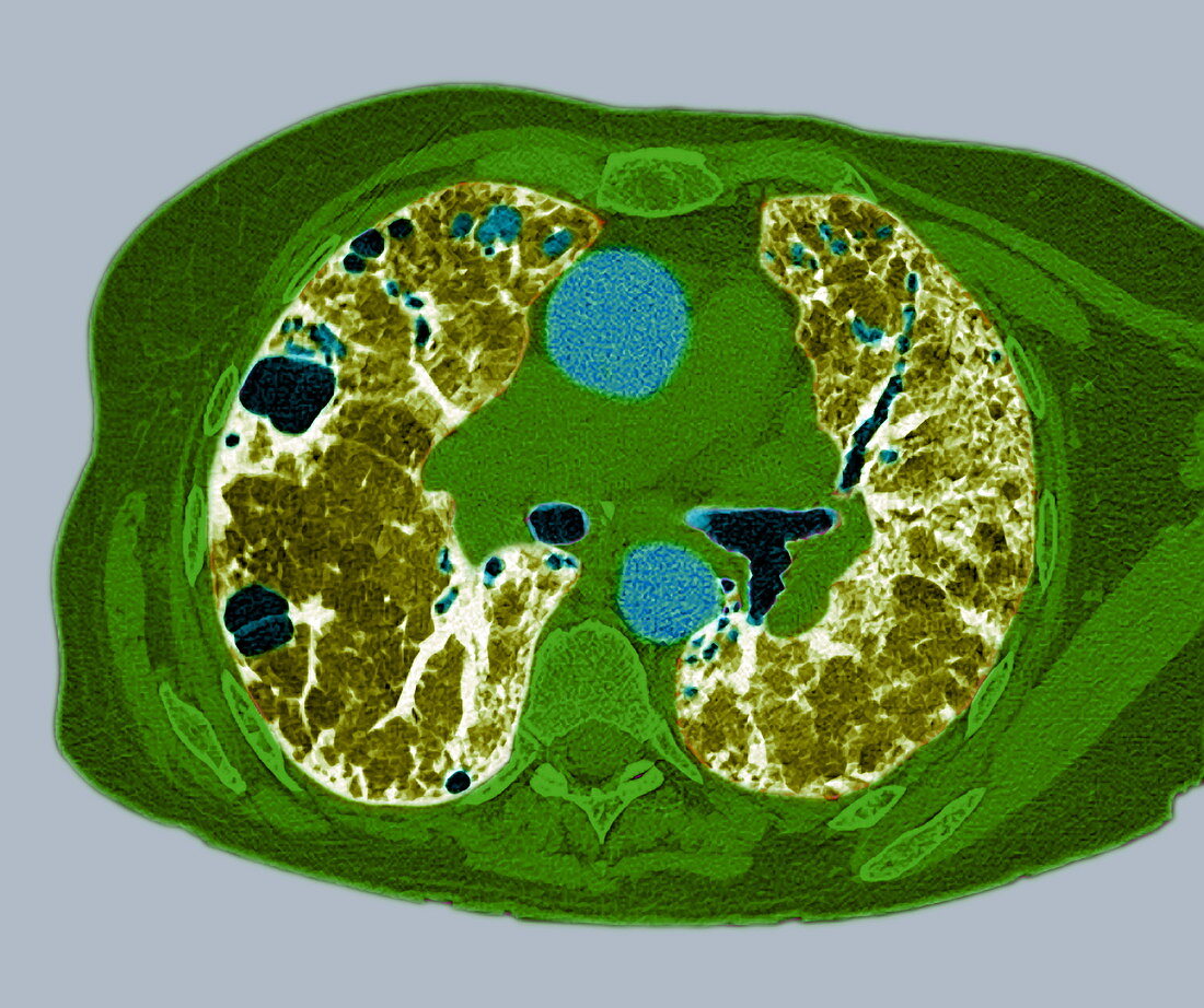 Lung fibrosis,CT scan