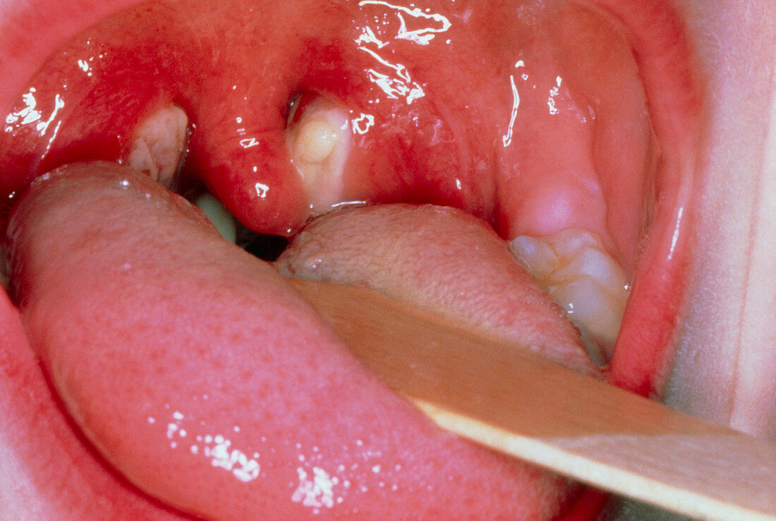 Infected tonsils in glandular fever