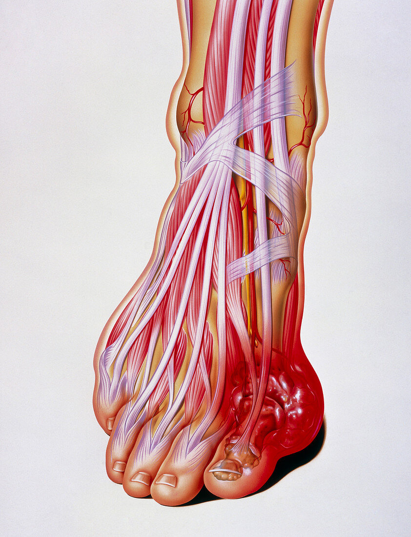 Artwork of gout: tophus at base of the big toe