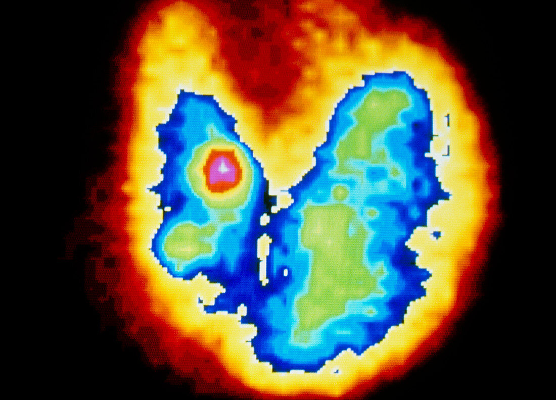 Coloured Gamma Scan of goitre of the thyroid gland