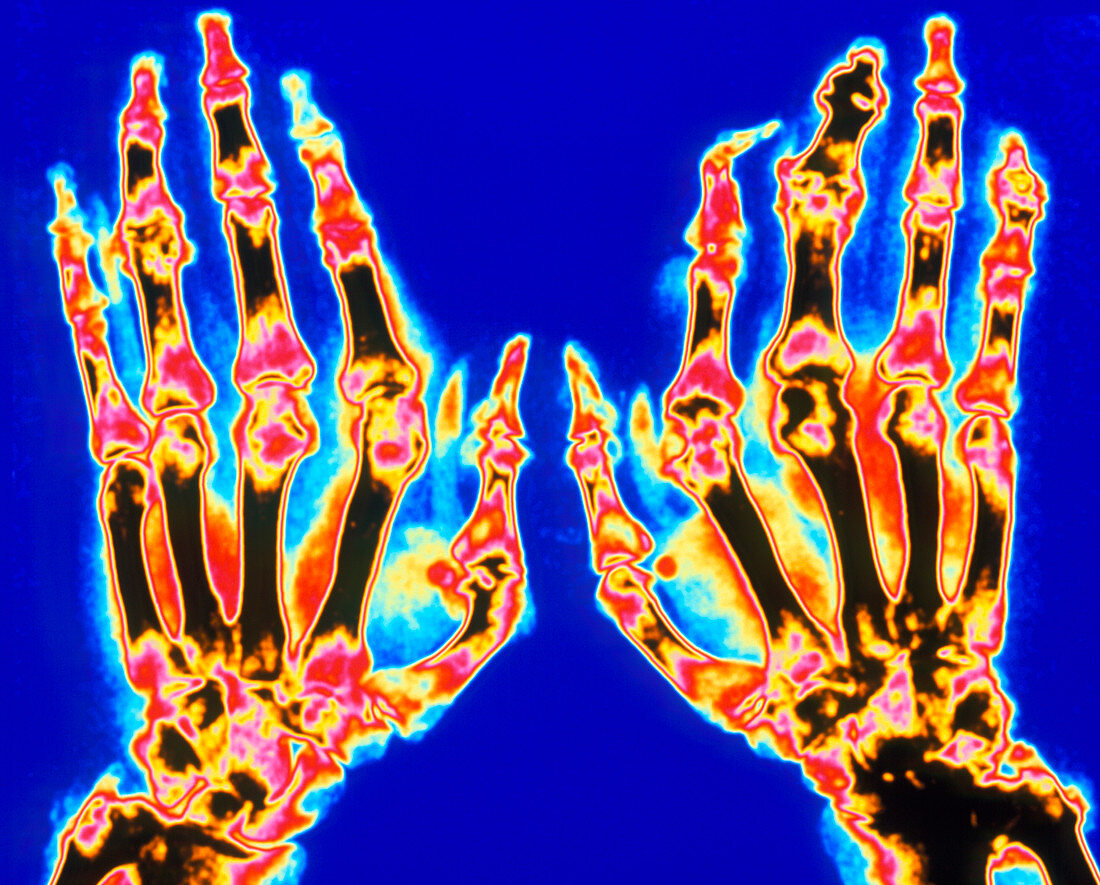 Coloured X-ray of hand in gouty arthritis