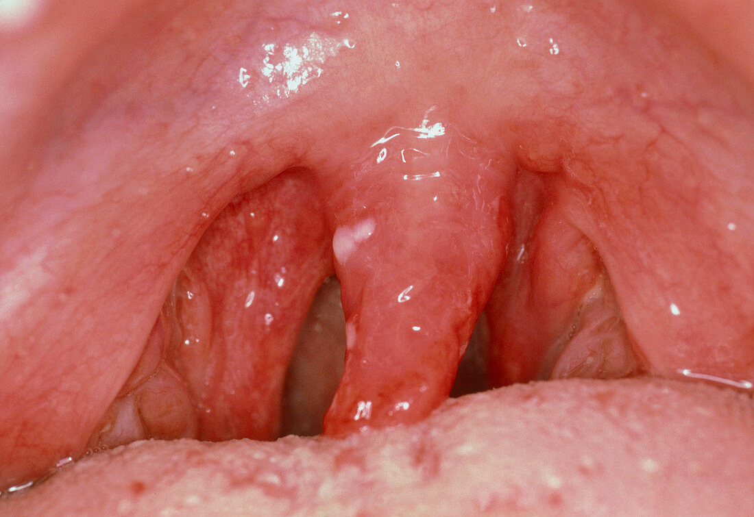 Tonsils of person with viral infection