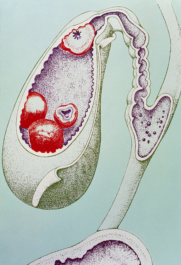 Artwork of gallstones in the gall bladder