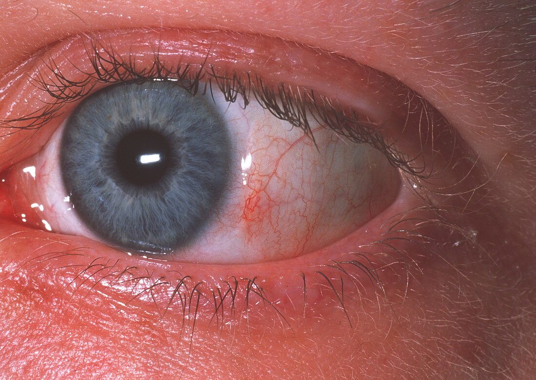 Eye scar