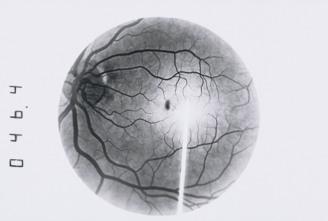 Retinal blood vessel disorder