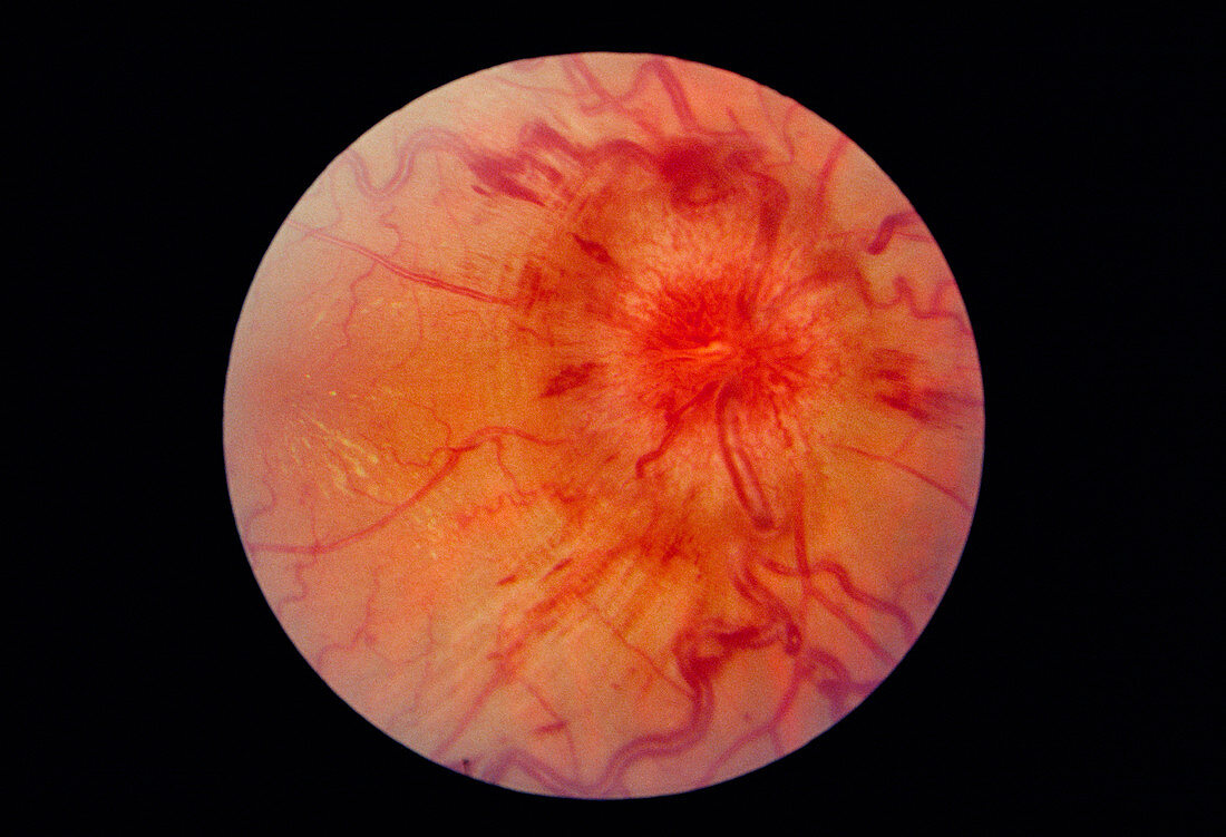 Papilloedema of the eye