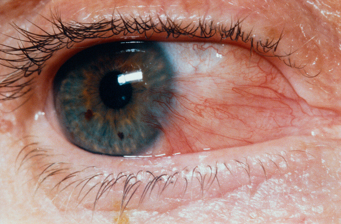 Pterygium of the eye