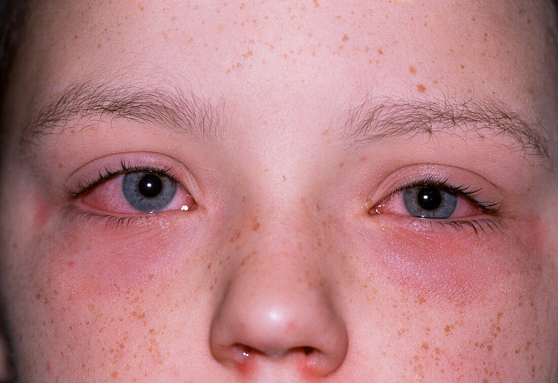 Allergic conjuctivitis