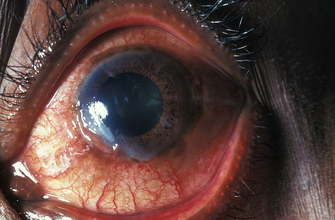 Ulcer of the eye